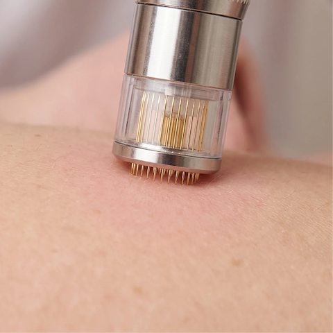 RF microneedling and microneedling