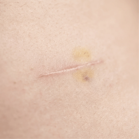 Abdominoplasty and breast surgery