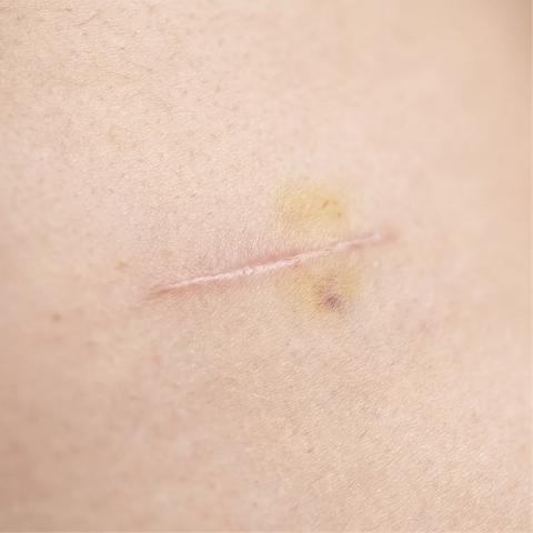 Abdominoplasty and breast surgery
