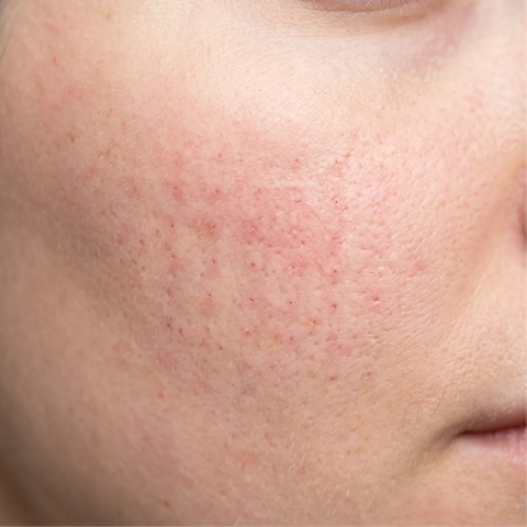 After microneedling and RF