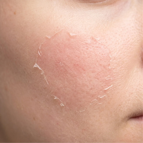 Chemical peels