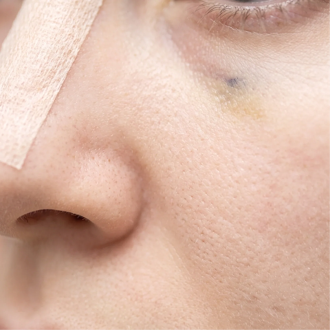 Rhinoplasty