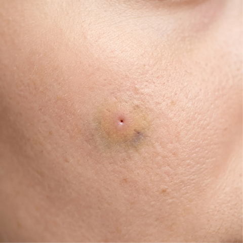 After injectables