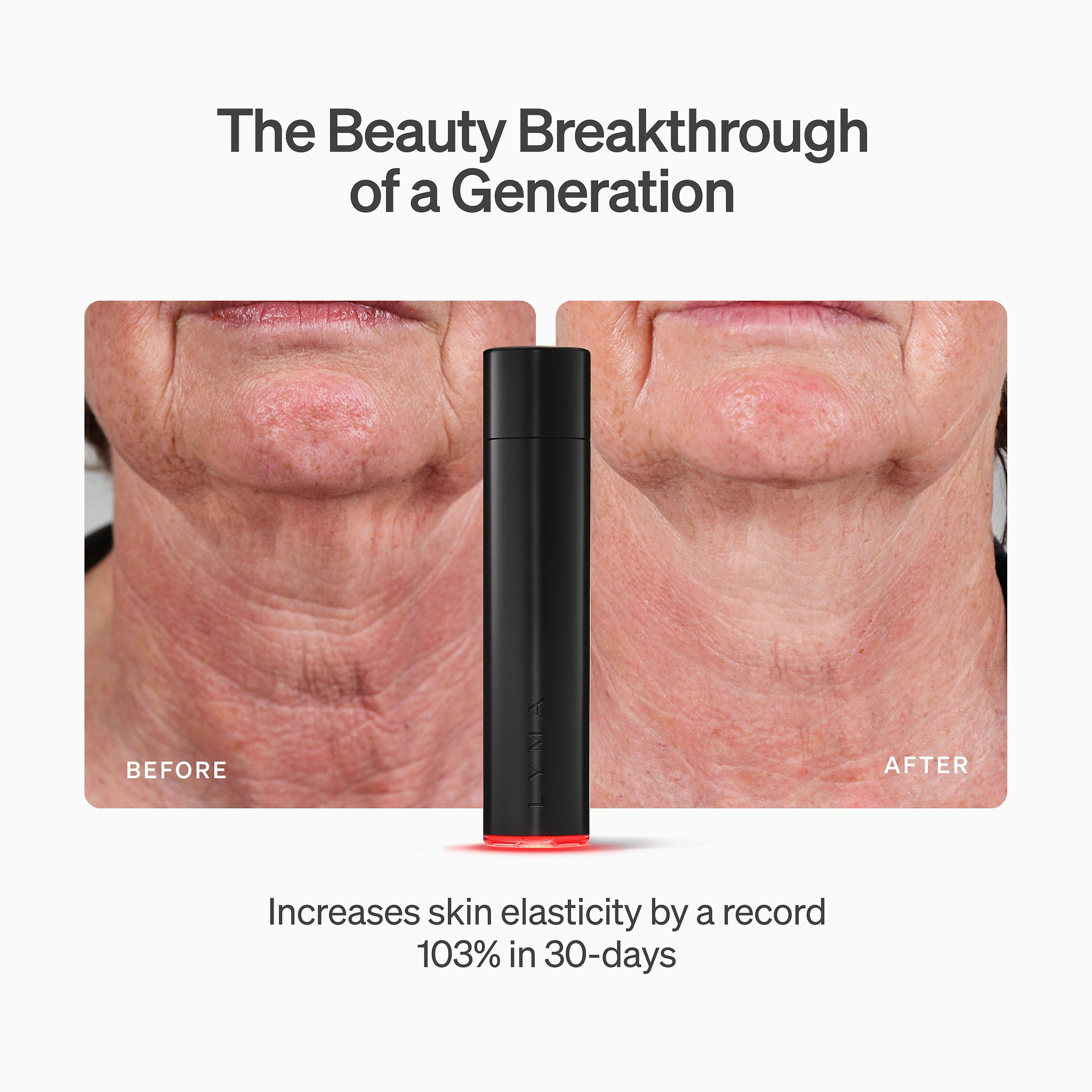 LYMA Laser - LYMA's breakthrough cold laser technology. Engineered to make you look younger.