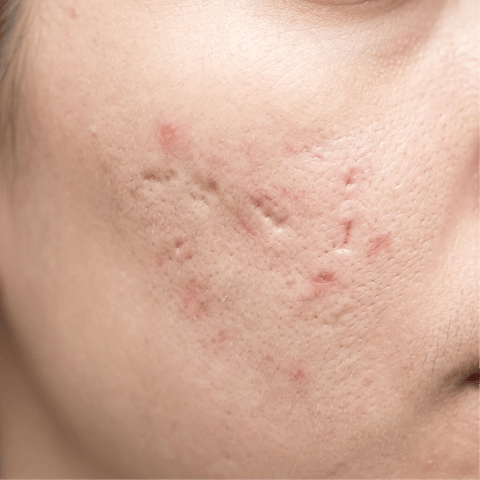 Acne scarring and post-inflammatory erythema