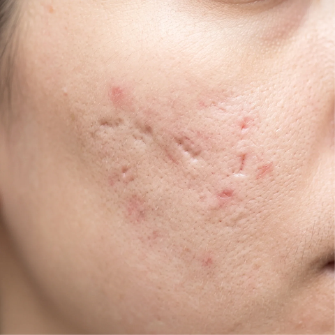 Acne scarring and post-inflammatory erythema