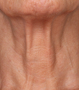 After image