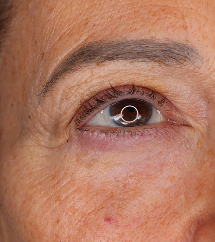 LYMA Laser - LYMA's breakthrough cold laser technology. Engineered to make you look younger.
