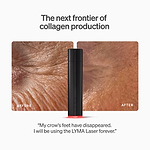 LYMA Laser - LYMA's breakthrough cold laser technology. Engineered to make you look younger.