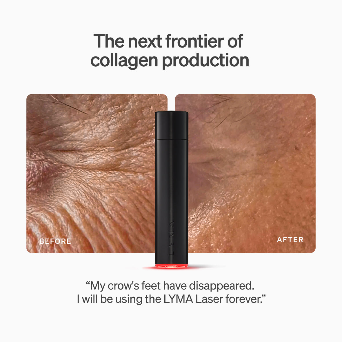 LYMA Laser - LYMA's breakthrough cold laser technology. Engineered to make you look younger.