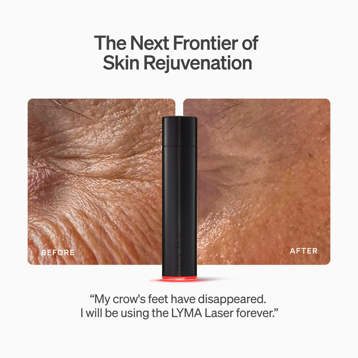 LYMA Youth System - Tighter jawline. Fewer wrinkles. Firmer neck. This is what happens when three technologies are engineered as one anti-ageing system.