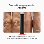 LYMA Laser - LYMA's breakthrough cold laser technology. Engineered to make you look younger.