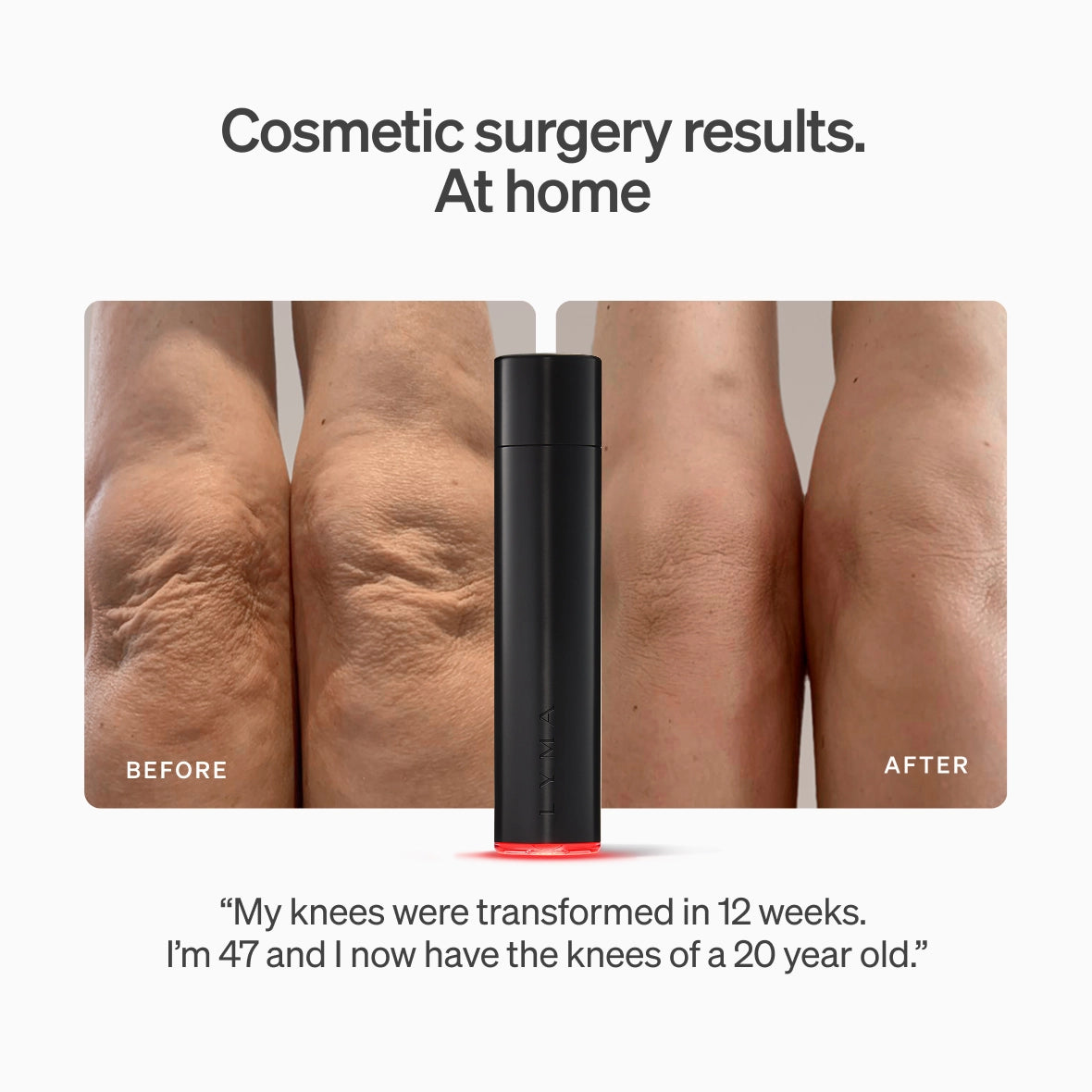 LYMA Laser - LYMA's breakthrough cold laser technology. Engineered to make you look younger.