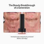 LYMA Laser PRO - LYMA's breakthrough cold laser technology. Younger skin. Bigger lens. Faster results.