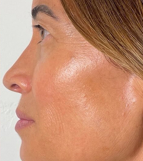 LYMA Laser PRO - LYMA's breakthrough cold laser technology. Younger skin. Bigger lens. Faster results.
