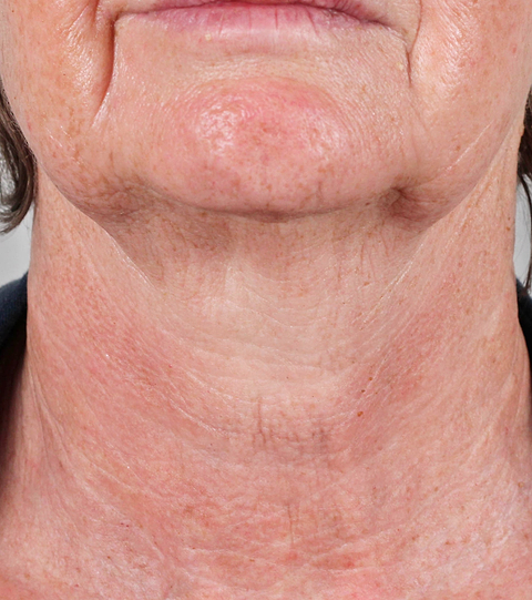 LYMA PRO Youth System - Tighter jawline. Fewer wrinkles. Firmer neck. This is what happens when three technologies are engineered as one anti-ageing system.
