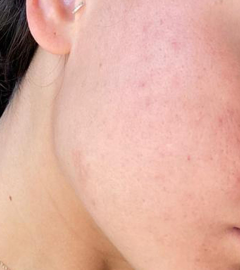 LYMA Youth System - Tighter jawline. Fewer wrinkles. Firmer neck. This is what happens when three technologies are engineered as one anti-ageing system.