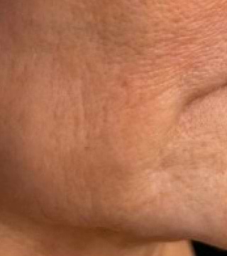 Layma Dermal LYMA. The Science of Youth. World-Leading Anti-Ageing Skin Lasers