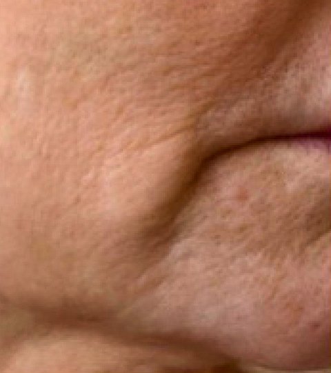 LYMA PRO Youth System - Tighter jawline. Fewer wrinkles. Firmer neck. This is what happens when three technologies are engineered as one anti-ageing system.