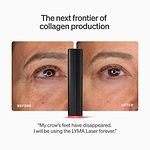 LYMA Laser - LYMA's breakthrough cold laser technology. Engineered to make you look younger.