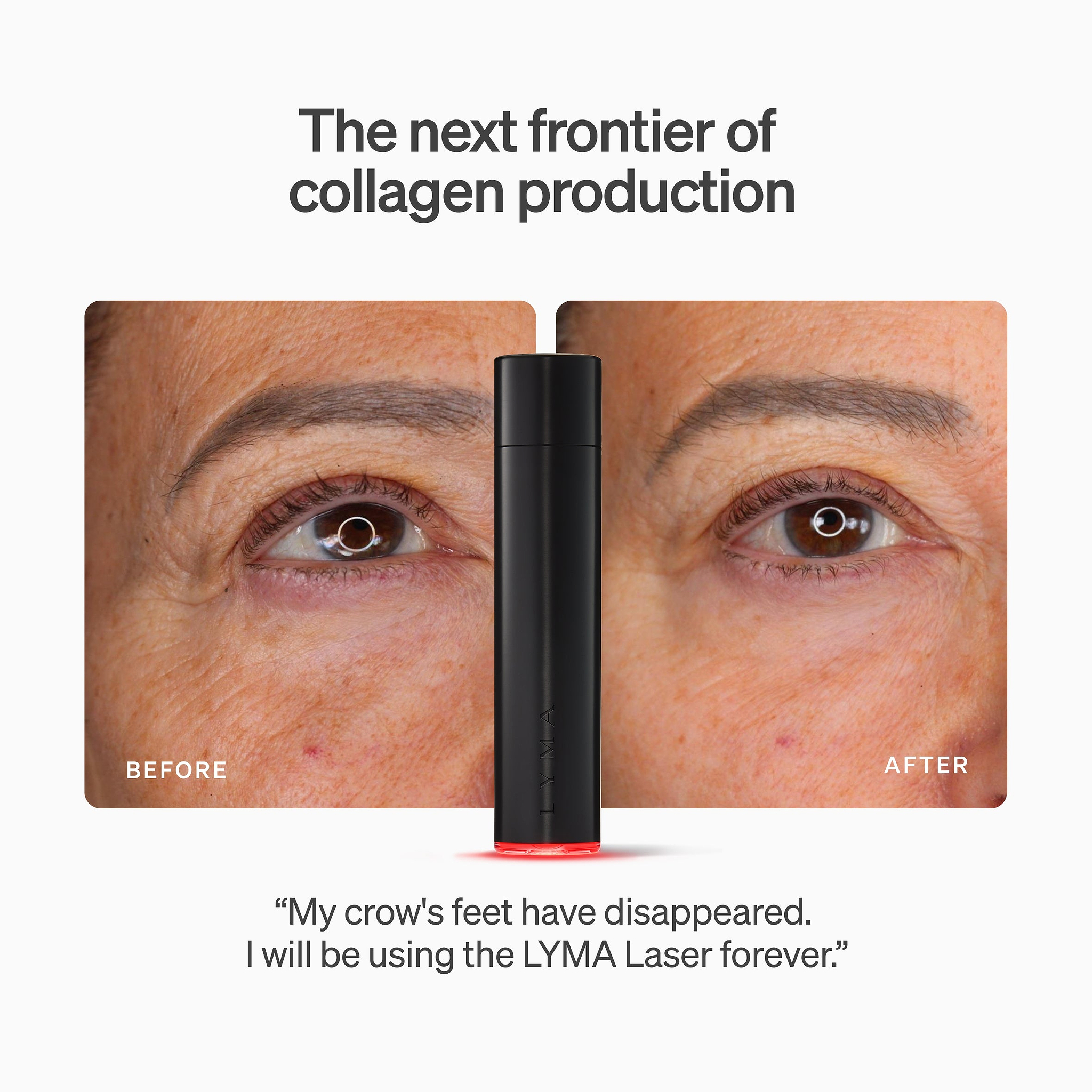 LYMA Laser - LYMA's breakthrough cold laser technology. Engineered to make you look younger.