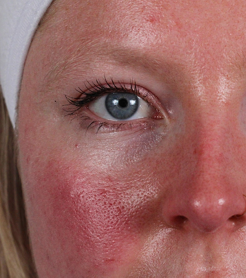 LYMA Laser PRO - LYMA's breakthrough cold laser technology. Younger skin. Bigger lens. Faster results.