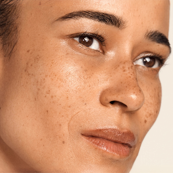4 Most Common Types of Skin Pigmentation and the Best Treatment for Each