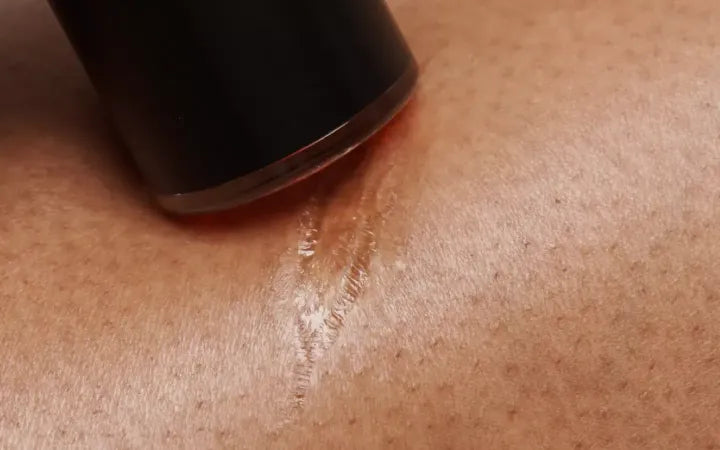 The scar treatment which is safe, effective, has zero side effects, and can be used from the comfort of your own home.