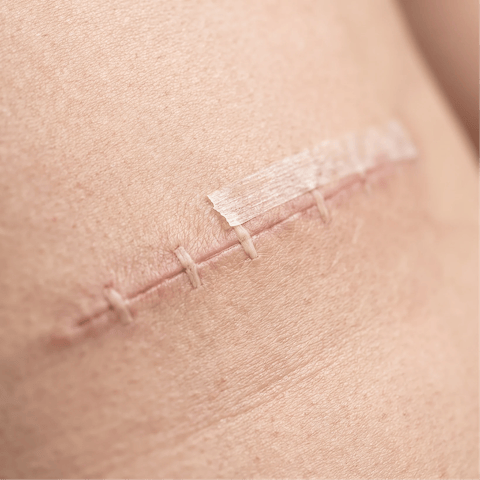 Body contouring after significant weight loss