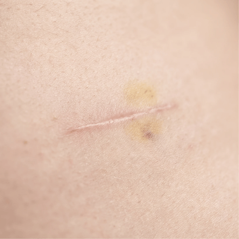 Abdominoplasty and breast surgery