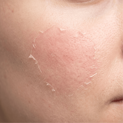 Chemical peels