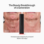 LYMA Laser - LYMA's breakthrough cold laser technology. Engineered to make you look younger.
