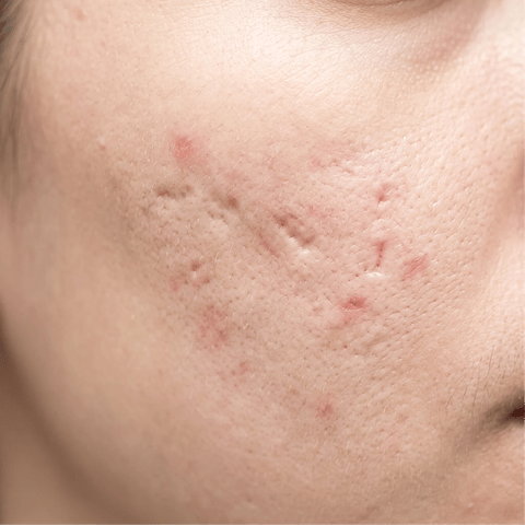 Acne scarring and post-inflammatory erythema