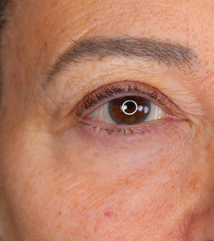 LYMA Laser - LYMA's breakthrough cold laser technology. Engineered to make you look younger.