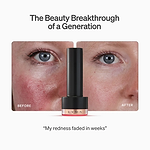 LYMA Laser PRO - LYMA's breakthrough cold laser technology. Younger skin. Bigger lens. Faster results.