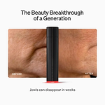 LYMA Laser - LYMA's breakthrough cold laser technology. Engineered to make you look younger.