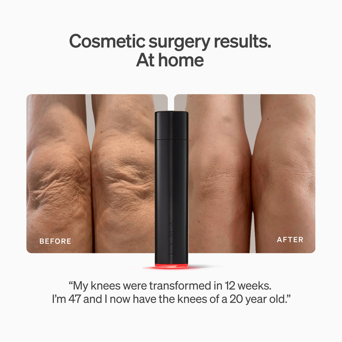The LYMA Laser - LYMA's breakthrough cold laser technology. Engineered to make you look younger.
