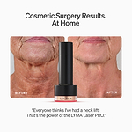 The LYMA Laser PRO - LYMA's breakthrough cold laser technology. Younger skin. Bigger lens. Faster results.