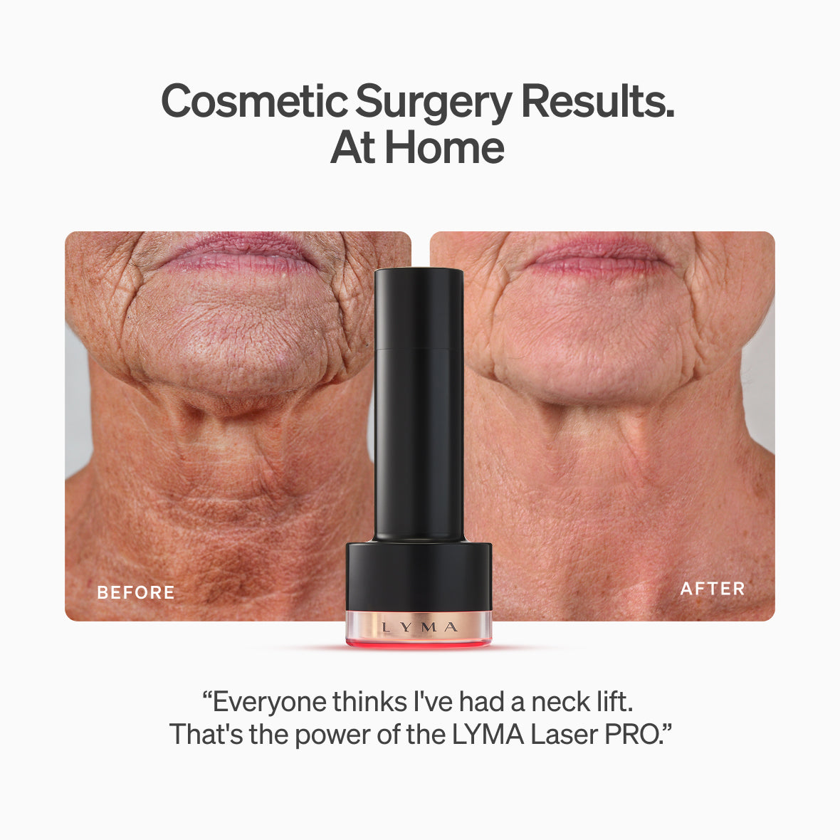 The LYMA Laser PRO - LYMA's breakthrough cold laser technology. Younger skin. Bigger lens. Faster results.