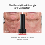 The LYMA Laser PRO - LYMA's breakthrough cold laser technology. Younger skin. Bigger lens. Faster results.