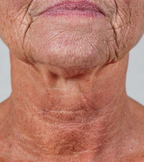 The LYMA PRO Youth System Longevity Edition - Tighter jawline. Fewer wrinkles. Firmer neck. This is what happens when three technologies are engineered as one anti-aging system.