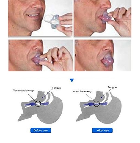 putting a snoring mouthpiece in