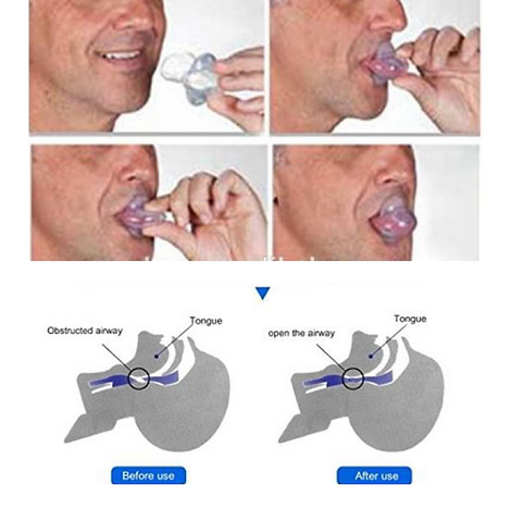 putting a snoring mouthpiece in