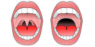 Uvulopalatopharyngoplasty surgery for snoring