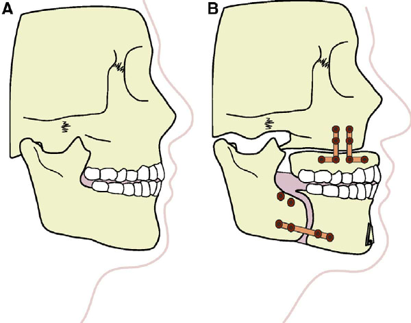 Maxillomandibular Advancement before and after