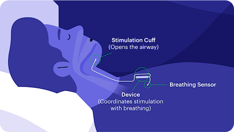 how does inspire work for sleep apnea
