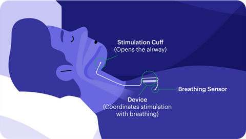 how does inspire work for sleep apnea