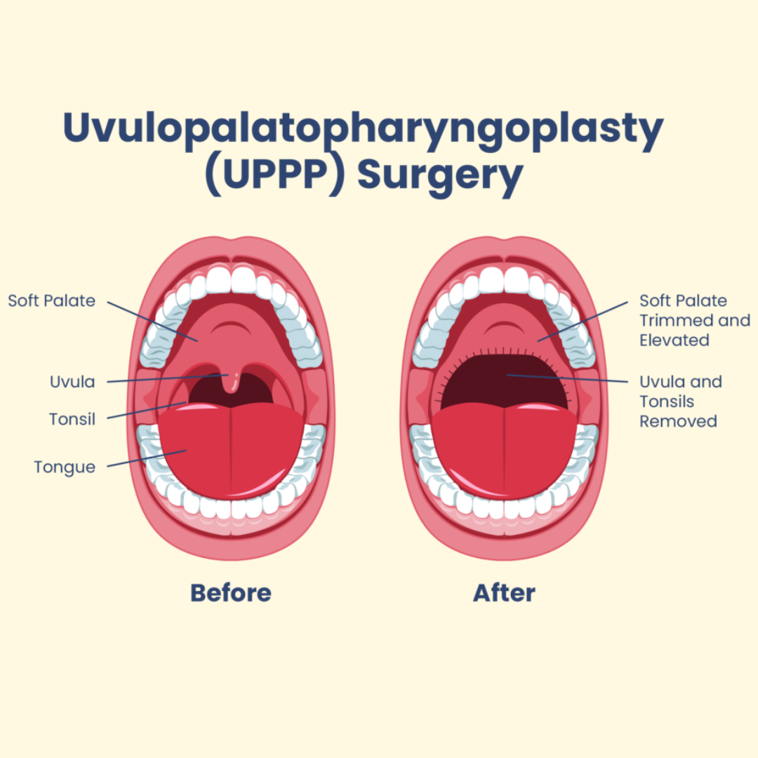 Uvulopalatopharyngoplasty (UPPP) surgery before and after