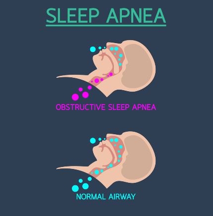 sleep apnea facts