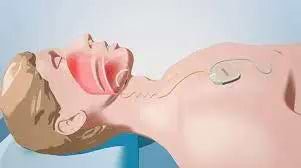 Inspire Therapy For Sleep Apnea - What Is It and How It Works